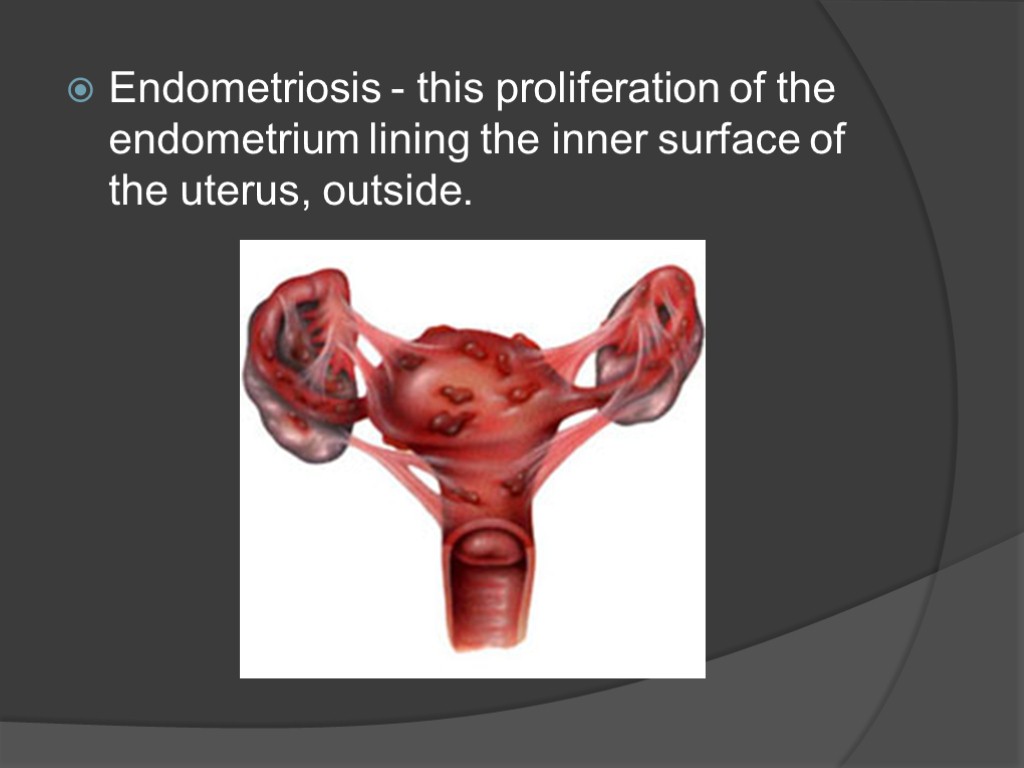 Endometriosis - this proliferation of the endometrium lining the inner surface of the uterus,